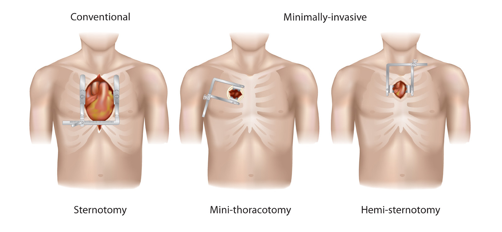 Surgical Access Final