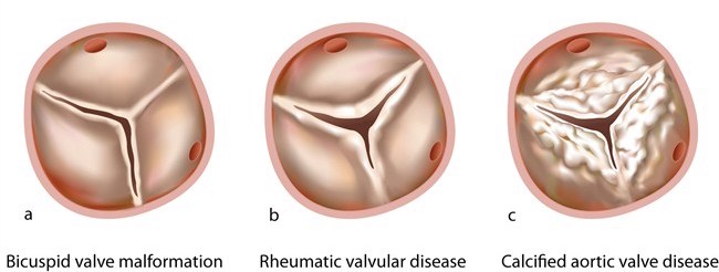 Aortic Valve Final